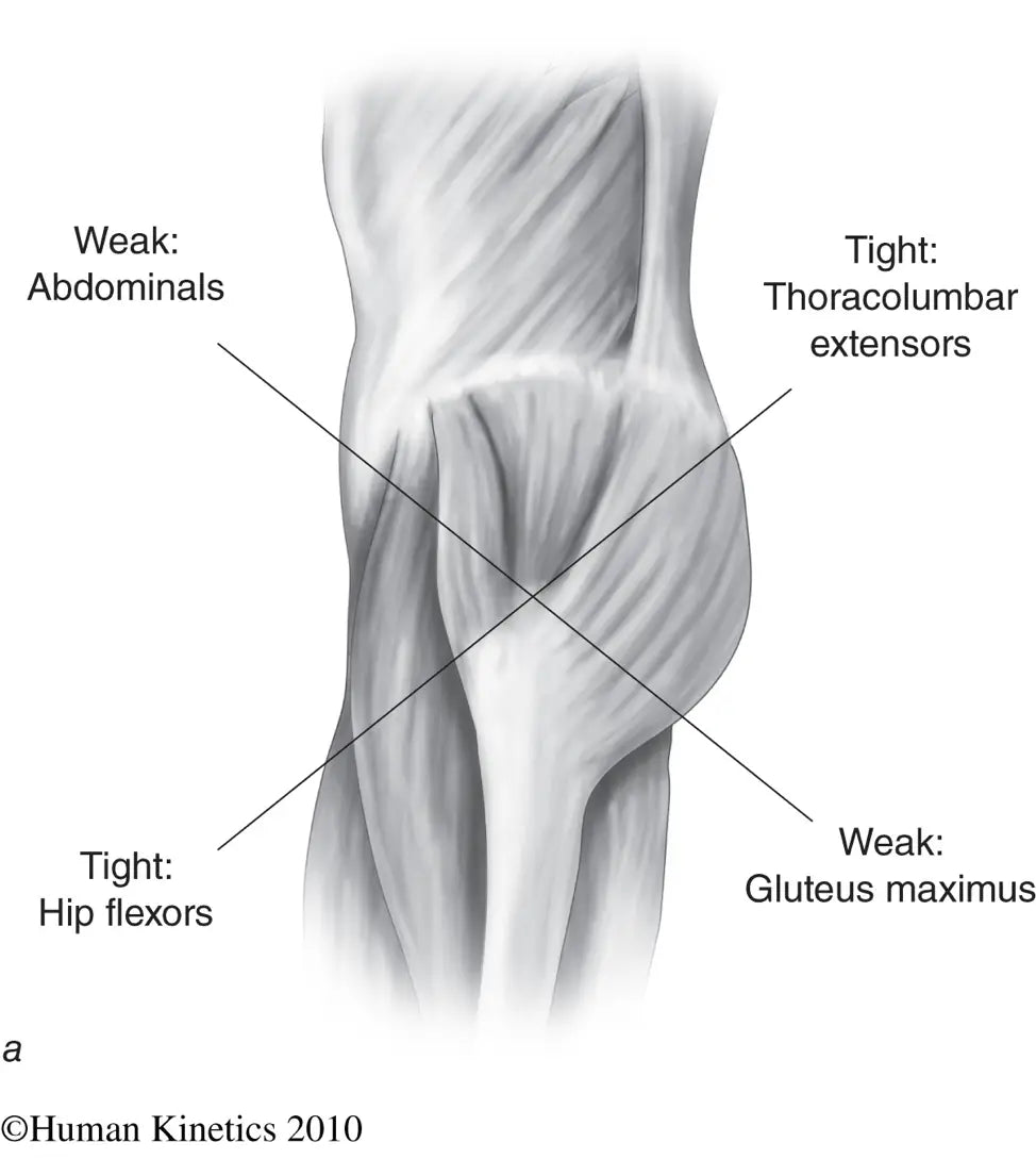 The Lower Crossed Syndrome