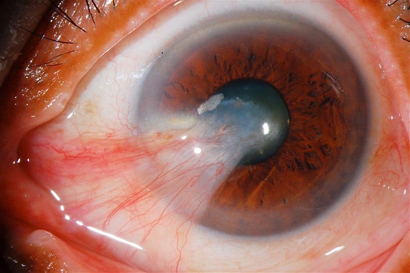 Surfer’s Eye—Treating and Preventing Pterygium