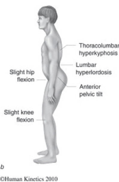 The Lower Crossed Syndrome