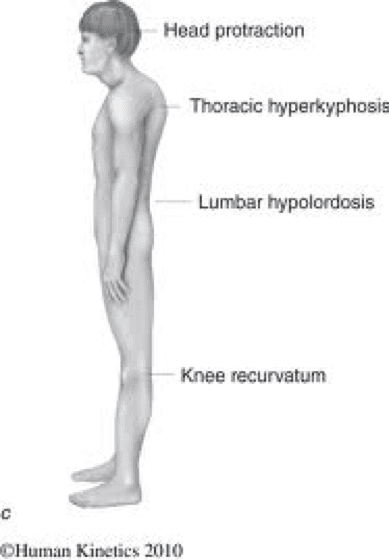 The Lower Crossed Syndrome