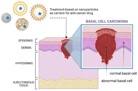 David Kelly’s Experience with Basal Cell Carcinoma